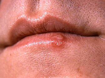 Version of coldsore virus coul...